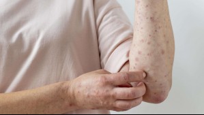 ¿Cómo se contagia el sarampión?: Los síntomas y medidas de prevención tras la emergencia sanitaria en Perú