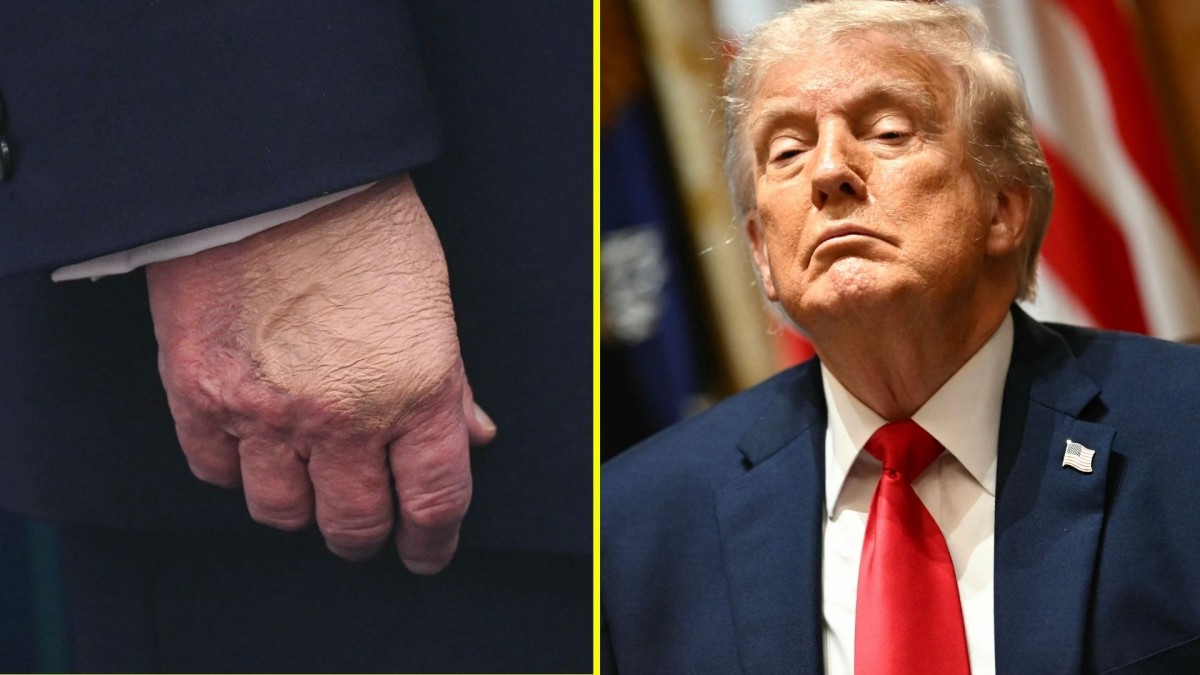 Médico de Trump dice que el mandatario está en 'excelente condición' y explica la razón de los moretones en sus manos