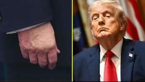 Médico de Trump dice que el mandatario está en 'excelente condición' y explica la razón de los moretones en sus manos