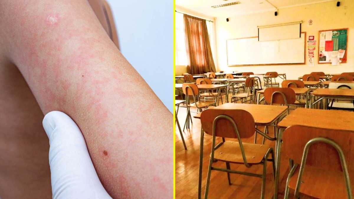 Detectan brote de Eritema infeccioso en colegio de la Araucanía: ¿Cuáles son los síntomas?