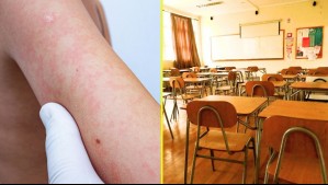 Detectan brote de Eritema infeccioso en colegio de la Araucanía: ¿Cuáles son los síntomas?