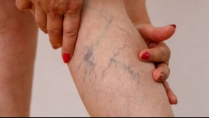 Bono Pad por varices: Este es el valor para el paciente