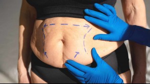 Bono PAD Abdominoplastía: Esto es el valor que debe pagar el paciente