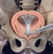 Un innovador método de detección del cáncer de próstata está mostrando resultados prometedores al reducir significativamente la cantidad de biopsias innecesarias que deben enfrentar los pacientes con sospechas de enfermedad.