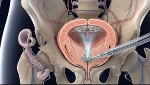 Revolución en la detección del cáncer de próstata: Examen podría evitar miles de biopsias
