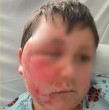 Médicos de Estados Unidos alertan sobre los juguetes sensoriales NeeDoh, que también se venden en Chile. Casos de niños con graves quemaduras reavivan el llamado a no calentarlos ni congelarlos.