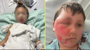 Médicos alertan por popular juguete antiestrés: Podría causar graves quemaduras en niños si se calienta o congela