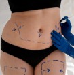 Las personas afiliadas a Fonasa pueden someterse a una cirugía para corregir un abdomen flácido pueden acceder al Bono PAD, un beneficio que permite conocer de antemano el costo total de la intervención y el copago que deberá asumir el paciente.