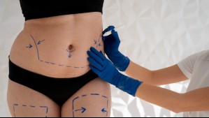 Bono PAD de Fonasa para abdomen flácido: Esto debe pagar el paciente