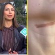 Una joven de Temuco denunció un accidente que sufrió el pasado martes 11 de agosto mientras regresaba a su casa en bicicleta. Aseguró que un cable de telecomunicaciones que se encontraba tendido en la vereda terminó enredándose en su cuello.