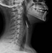 El paciente utilizó una parrilla que fue limpiada con una escobilla metálica. Los exámenes posteriormente revelaron que había ingerido accidentalmente una delgada hebra de metal de aproximadamente 3 centímetros, que quedó atrapada en su garganta.