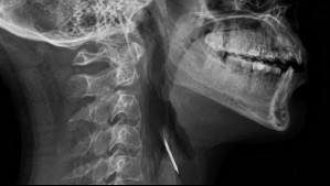 Limpió la parrilla con escobilla de metal y terminó en el hospital: Tenía una hebra clavada en la garganta