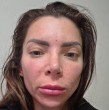 La bailarina Geri Hoops relató la complicación médica que enfrenta tras un procedimiento estético. Fue diagnosticada con celulitis facial y presentó una alteración en el movimiento de su ojo derecho.