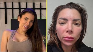 Conocida bailarina sufre infección facial tras procedimiento estético: 'Estoy con mucha ansiedad, no puedo dormir bien'