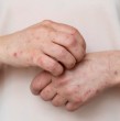 La confirmación del tercer caso de sarampión registrado en Chile durante 2026 mantiene las alertas epidemiológicas del Ministerio de Salud (Minsal) debido a la alta transmisibilidad de esta enfermedad.