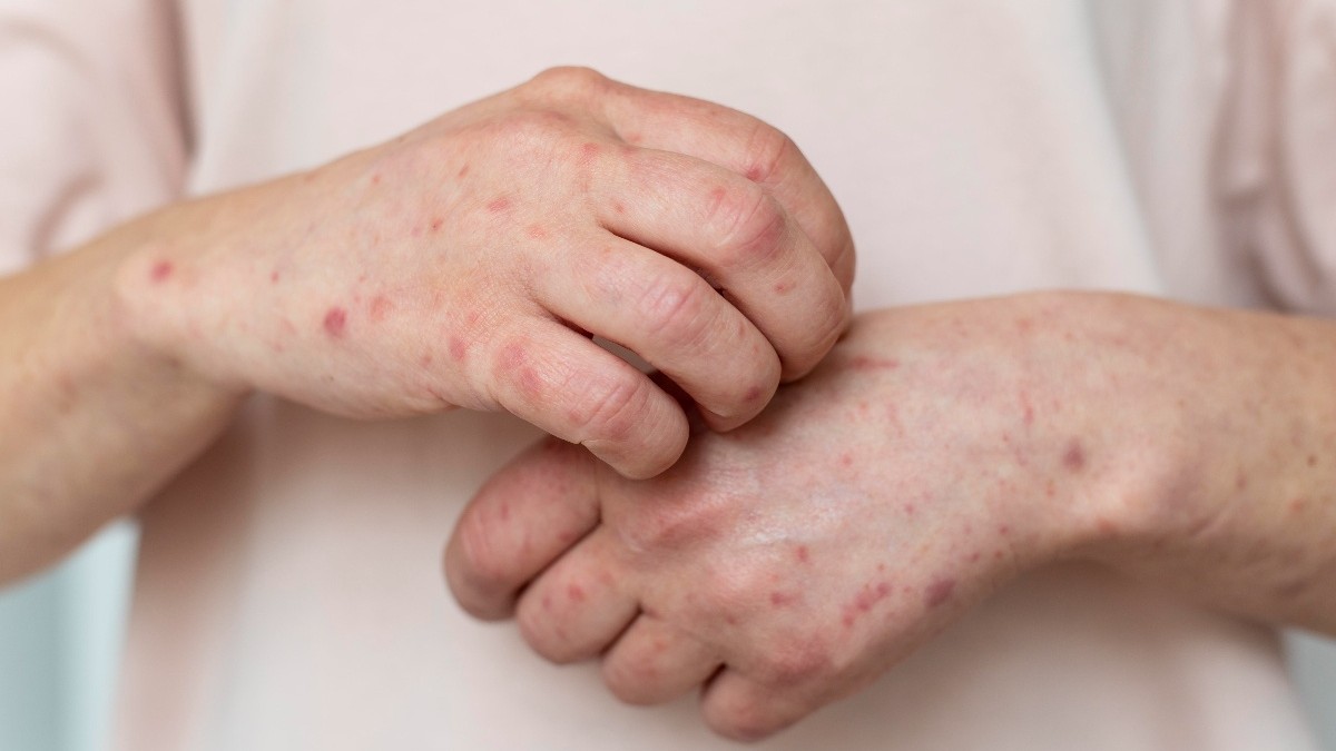 Tras tercer caso confirmado de sarampión: ¿Cuáles son los síntomas del virus?