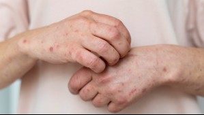 Tras tercer caso confirmado de sarampión: ¿Cuáles son los síntomas del virus?
