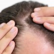 Un fármaco utilizado para tratar enfermedades inflamatorias podría abrir una nueva alternativa para personas con alopecia severa, tras ser evaluado en dos ensayos clínicos con resultados alentadores.