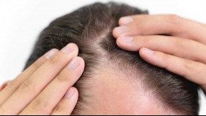 ¿Adiós a la calvicie?: Descubren que fármaco para la artritis podría curar la alopecia severa