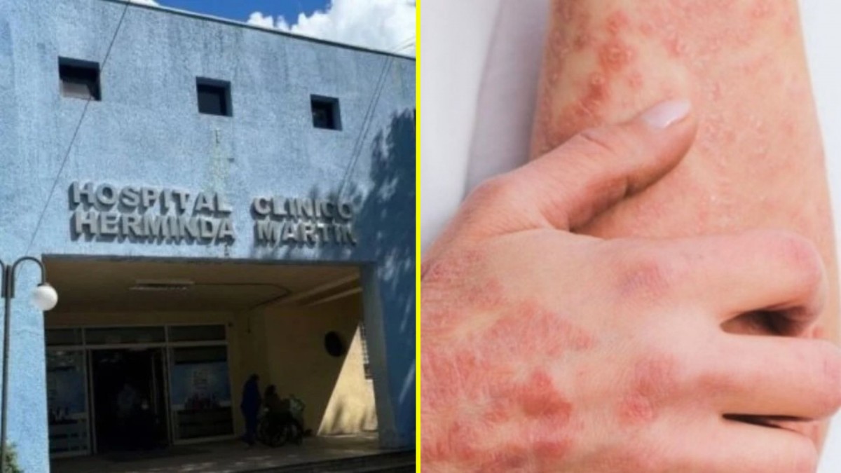 Brote de sarna Noruega en Chile: Hospital de Chillán reportó atención de 13 casos en el recinto