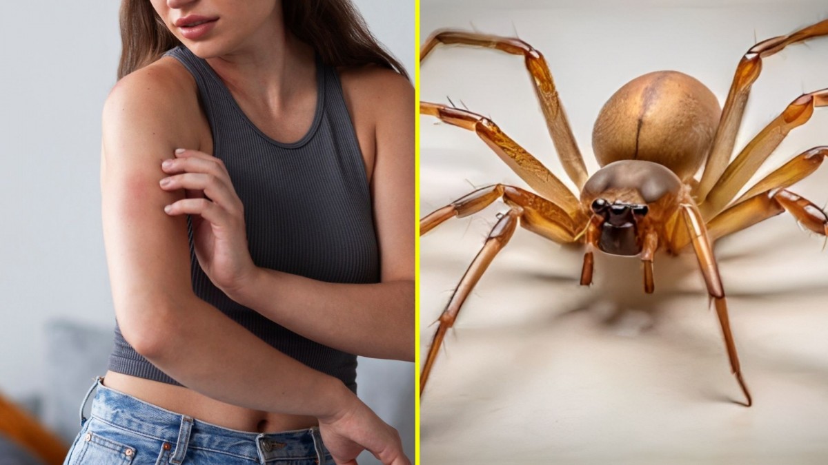 Tras caso en Coquimbo: qué hacer ante una picadura de araña de rincón